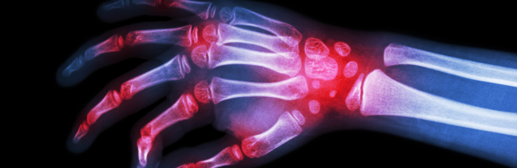 Arthritis Bones